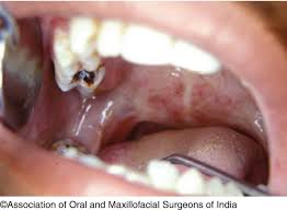 Image result for spinocellular carcinoma of the oral cavity
