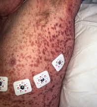 At initial stages, bruises are seen … Diffuse Petechial Rash In An Unwell Febrile Patient Medicine Today
