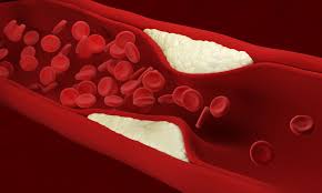 Crush the garlic and let it sit for 15 minutes. Drugs With Potential To Stop Plaque Build Up In Arteries Identified