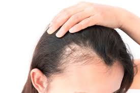 Maybe you would like to learn more about one of these? Ini 5 Cara Mudah Dan Alami Mengatasi Rambut Rontok Parah Womantalk