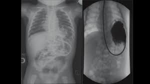 Image result for Volvulus