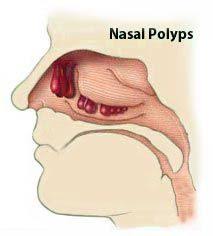 They can be caused by allergies or any sort of irritation within the nasal passage.v161604_b01. 7 Best Sinus Polyps Ideas Polyp Sinus Polyps Sinusitis