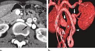 Retroaortic Left Renal Vein Causing Hypertension And Hematuria In A Download Scientific Diagram
