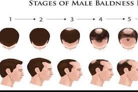 These symptoms of baldness are associated with the male sex androgens. Male Pattern Baldness Hair Loss Condition Problems