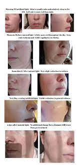 One for me (wrinkles) and one for my daughter (acne) at the end of 30 treatments i see better i had an extremely severe case of rosacea and i started using the neutrogena light therapy acne mask along with the acne face treatment kit. Review Broadband Light Bbl For Type 1 Rosacea Skincareaddiction