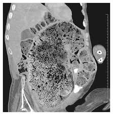 Image result for Acute Constipation