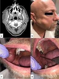 Image result for Sialoadenitis