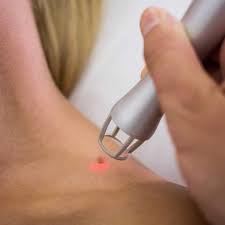 Por Que Salen Verrugas En El Cuello