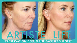 Face Lift Procedure