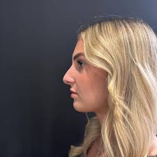 LONDON CLINIC 📍Oxford street December 12th BOOK NOW via the link in the  bio • • • #liquidrhinoplasty #london #londonaesthetics #aestheticslondon  #rhinoplastylondon #beforeandafter e