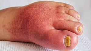 Image result for erysipel photos)