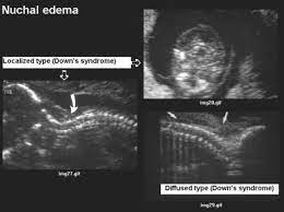 General Features Of Down Syndrome