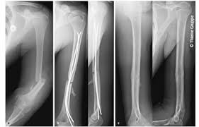 Frakturen Und Gelenkverletzungen An Der Oberen Extremitat Beim Kind Orthopadie Georg Thieme Verlag