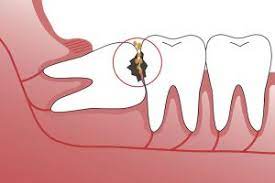 The recovery was perfectly fine, except for. Wisdom Teeth Faq Calgary Ab Foundation Oral Surgery