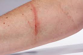 Early treatment with antibiotics and intravenous fluids improves chances. Roter Strich Anzeichen Fur Eine Blutvergiftung