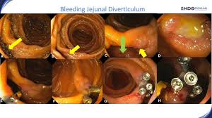 Image result for Colonoscopy in GI Bleeding