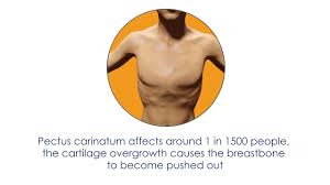 Pectus carinatum can be treated with either a brace or surgery. What Is Pectus Carinatum Youtube