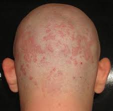 Kulat boleh berlaku pada bahagian: Kulat Merah Pada Badan Penyakit Kulat Kulit Gejala Dan Rawatan