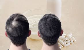 The great news is that with proper diet and supplementation, this type of hair loss is reversible.. Hair Loss Treatment Take This Natural Supplement To Increase Hair Count And Thickness Sound Health And Lasting Wealth
