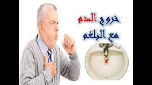 سبب خروج الدم من الفم عند الاستيقاظ من النوم