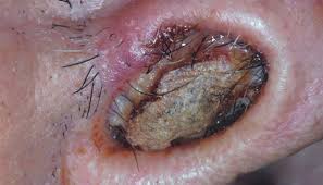 A nasal vestibulitis is an inflammation of the skin within the area of the nasal vestibule. A 52 Year Old Man With A Lesion In His Nose Cancer Therapy Advisor
