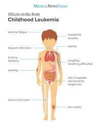 The symptoms of blood cancer. Pin On Health