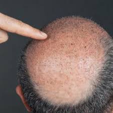 An afro hair transplant is transferring follicular units from a healthy donor area at the back of the head to the area suffering from hair loss. African American Hair Transplant Estepera