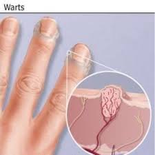 Natural Cure For Warts How To Cure Warts Naturally Home Remedies Natural Remedy Home Health Remedies Home Remedies For Warts Natural Home Remedies