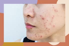 Skin lesions that are the result of fat accumulation in skin immune cells; How To Treat Cystic Acne According To Dermatologists Hellogiggles