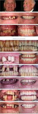 What are temporary partial dentures? Denture Implants Implant Retained Dentures Procedure Costs Faq Electric Teeth