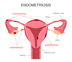 You could have only one, or you could have a cyst on each of your ovaries. Endometriosis Surgery Treatment Melbourne A Prof Alex Ades