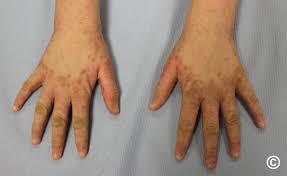 Image result for scabies norvegica