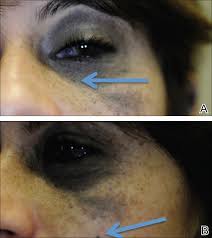 Image result for nevus sclerae
