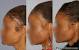 Apple Cider Vinegar Hair Growth Recipe