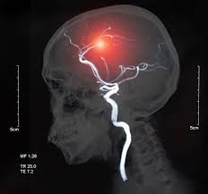 Un portal pentru femeile care au ceva de spus. Atacul Vascular Cerebral Simptome Si Tratament Centrokinetic