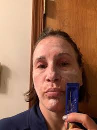 I have dermatillomania (skin picking), with the majority of it