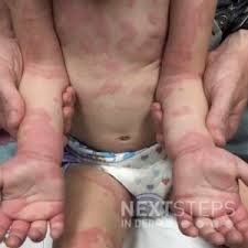 Image result for Dermatographism