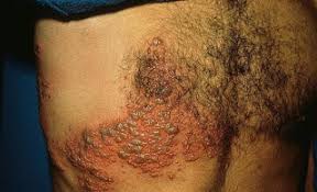 Sering disingkat hiv) adalah dua spesies lentivirus penyebab aids. Foto Foto Dan Tanda Dan Gejala Penyakit Hiv Aids Hiv Aids