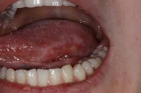Image result for lichen planus on tongue)