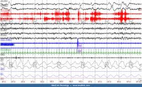Image result for REM Sleep Behavior Disorder