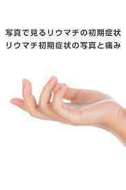リウマチの初期症状 関節リウマチ 関節 症状