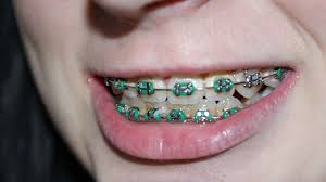 You are bound to hurt yourself by trying to remove braces work by moving teeth to the desired position. How Long Do You Have To Wear Braces Hawaii Family Dental