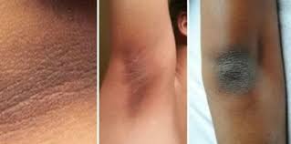 7 cara putihkan kulit hitam pada ketiak, leher, siku & lutut secara semula jadi. Cara Memutihkan Miss V Yang Makin Gelap Lepas Bersalin 3 Cara Semula Jadi Theasianparent Malaysia