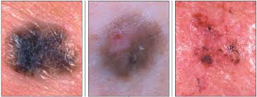 But the good news is, if it's found early, there's a higher the most obvious warning signs for melanoma are changes to your skin or moles. Melanoma Or Mimic Consultant360