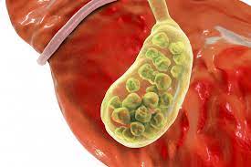 Unfortunately, drinking coffee can worsen gallbladder symptoms and inflammation pain due increasing contractions in already inflamed tissue. Gallbladder Inflammation Symptoms Signs Complications And Causes