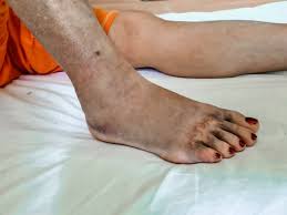 В Челнах медики спасли пожилую женщину после укуса гадюки | 12.07.2022 |  Казань - БезФормата