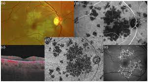 Have you experienced a rapid loss of vision that eventually has. Multimodal Imaging Of Acute Posterior Multifocal Placoid Pigment Download Scientific Diagram
