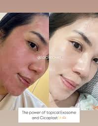 Iya nih kak kalo ada exosome semua jadi cepet banged kemerahannya hilang dan  barrier kuat🥰✨