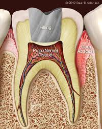 You can dd clove, peppermint, and cinnamon essential oils for how to get rid of a gum boil. Gum Injuries Schaefer Dental Group