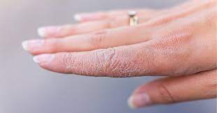 Terms in this set (22). Dishidroza Un Rezultat Al Stresului